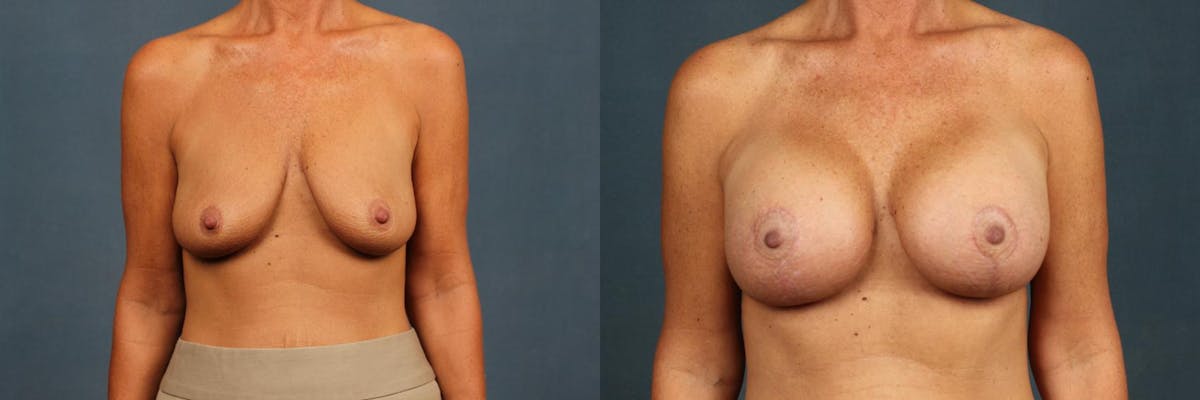 Lift Before & After Gallery - Patient 317079 - Image 1
