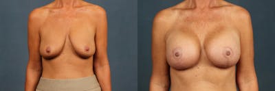 Lift Before & After Gallery - Patient 317079 - Image 1