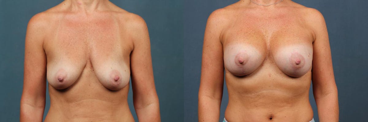 Lift Before & After Gallery - Patient 400226 - Image 1