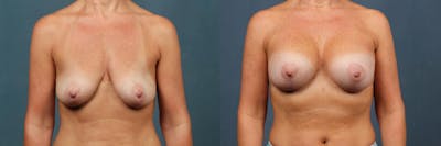 Lift Before & After Gallery - Patient 400226 - Image 1