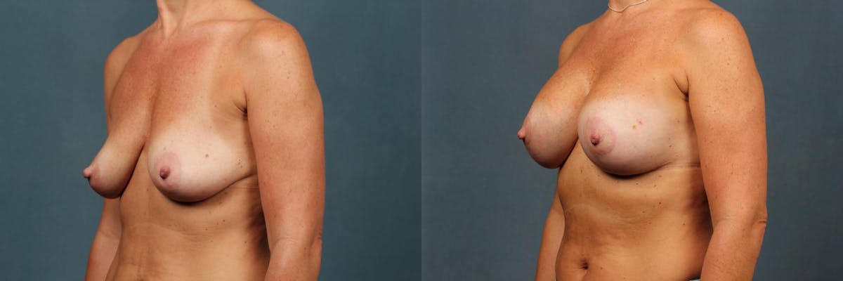 Lift Before & After Gallery - Patient 400226 - Image 2