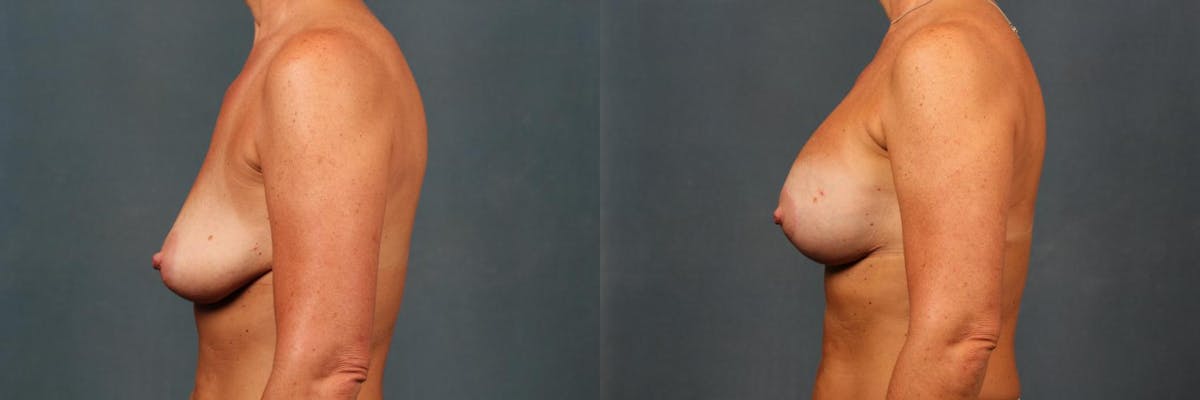 Lift Before & After Gallery - Patient 400226 - Image 3