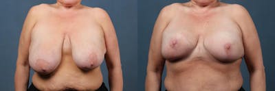 Lift Before & After Gallery - Patient 254715 - Image 1
