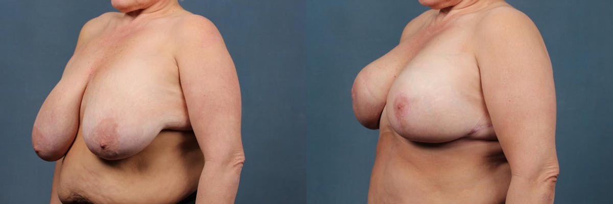 Lift Before & After Gallery - Patient 254715 - Image 2