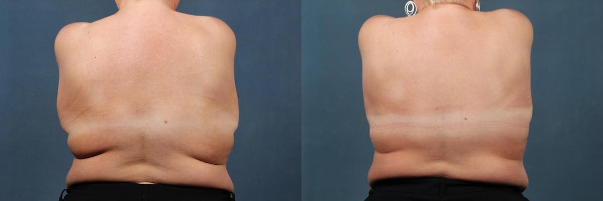 Lift Before & After Gallery - Patient 254715 - Image 4