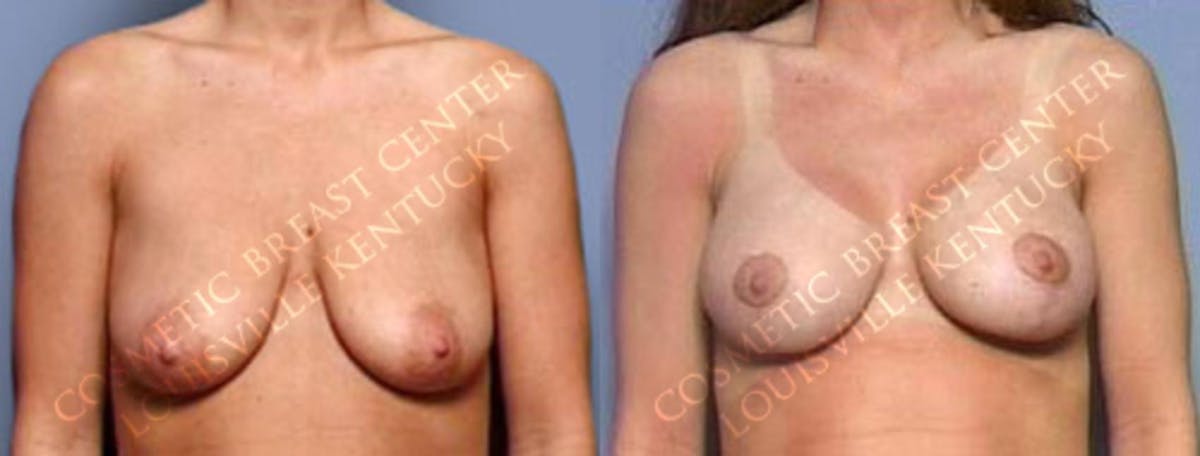 Lift Before & After Gallery - Patient 177979 - Image 1