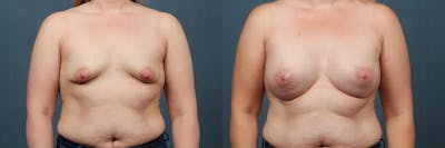 Lift Before & After Gallery - Patient 560862 - Image 1