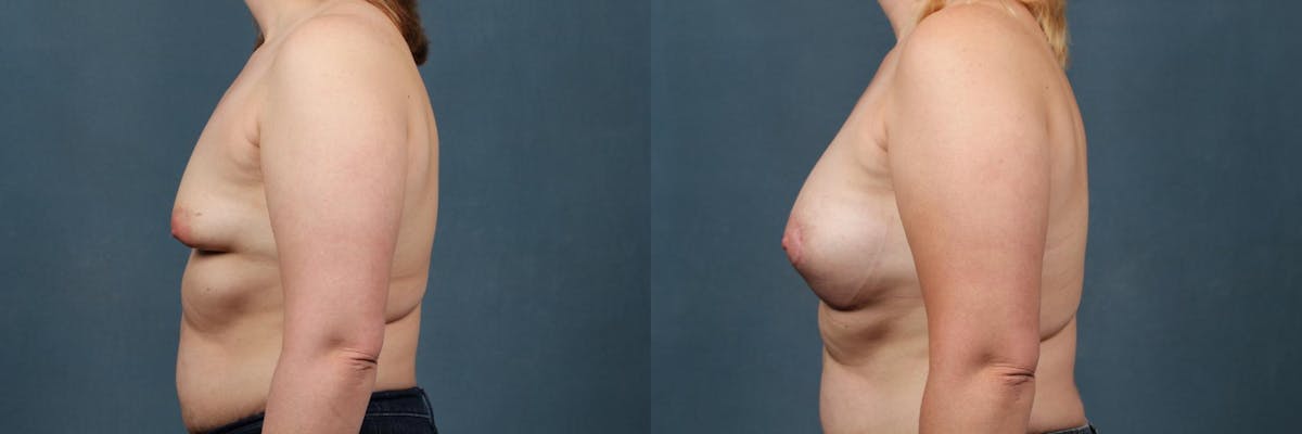 Lift Before & After Gallery - Patient 560862 - Image 2