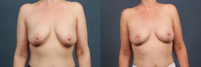 Lift Before & After Gallery - Patient 154144 - Image 1
