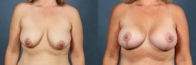Lift Before & After Gallery - Patient 201320 - Image 1