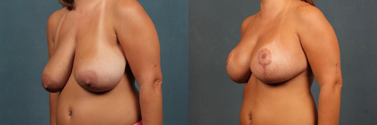 Lift Before & After Gallery - Patient 222755 - Image 2