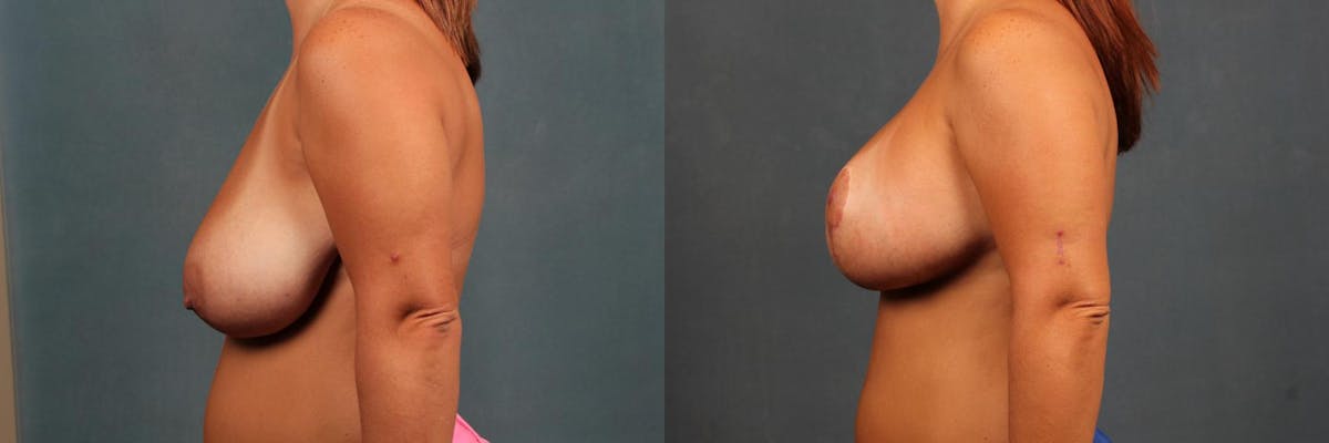 Lift Before & After Gallery - Patient 222755 - Image 3