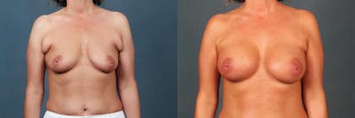 Lift Before & After Gallery - Patient 340836 - Image 1