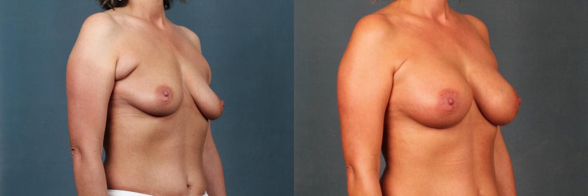 Lift Before & After Gallery - Patient 340836 - Image 2