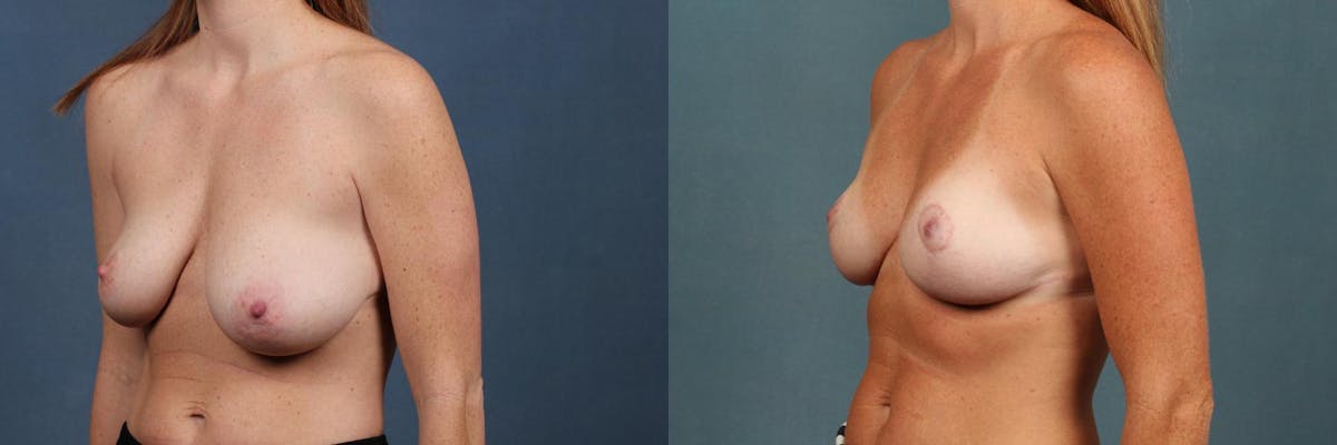 Lift Before & After Gallery - Patient 421867 - Image 2