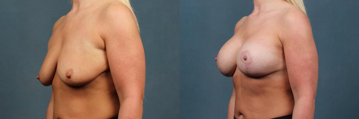Lift Before & After Gallery - Patient 405260 - Image 2