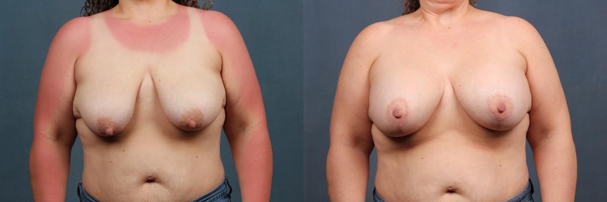 Lift Before & After Gallery - Patient 233543 - Image 1