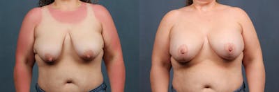 Lift Before & After Gallery - Patient 233543 - Image 1
