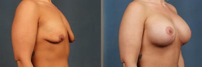 Lift Before & After Gallery - Patient 396454 - Image 1