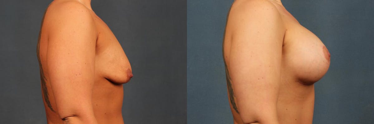 Lift Before & After Gallery - Patient 396454 - Image 2