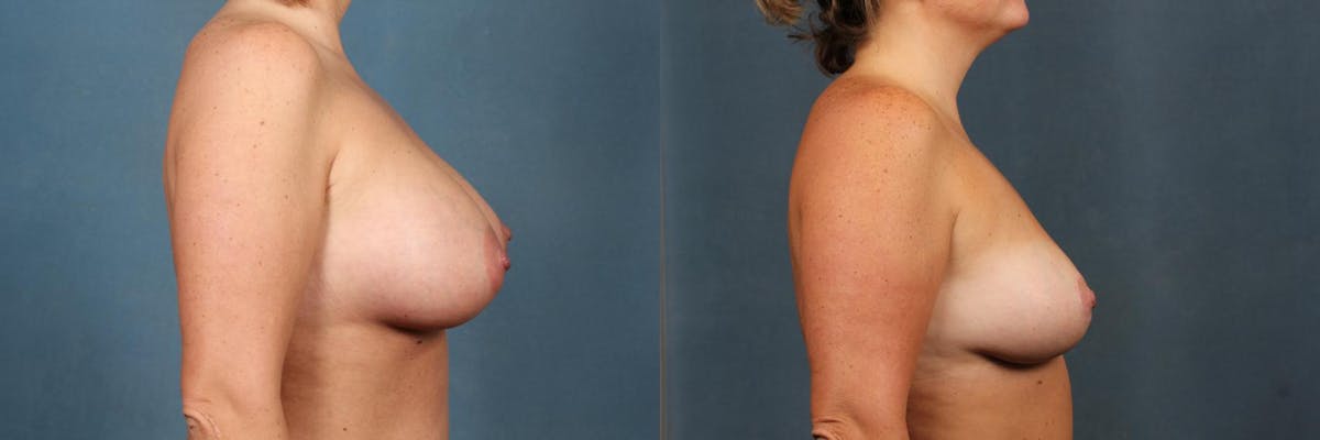 Lift Before & After Gallery - Patient 198385 - Image 3
