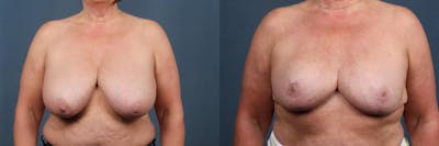 Lift Before & After Gallery - Patient 326332 - Image 1