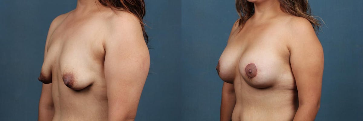 Lift Before & After Gallery - Patient 395635 - Image 2