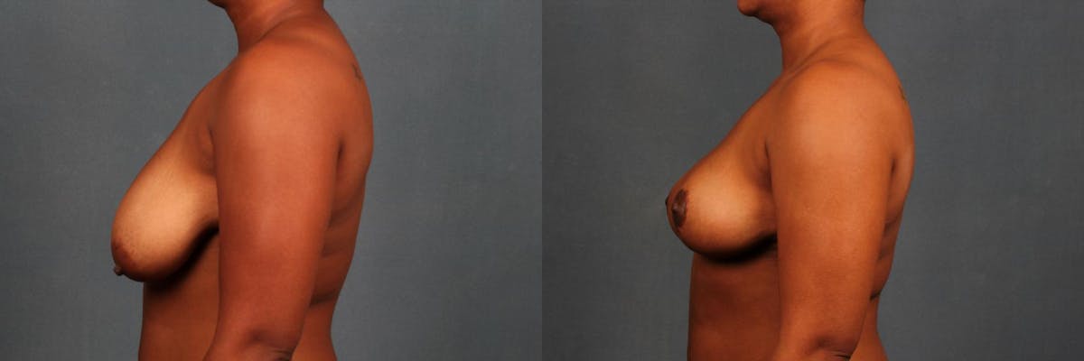 Lift Before & After Gallery - Patient 102889 - Image 3