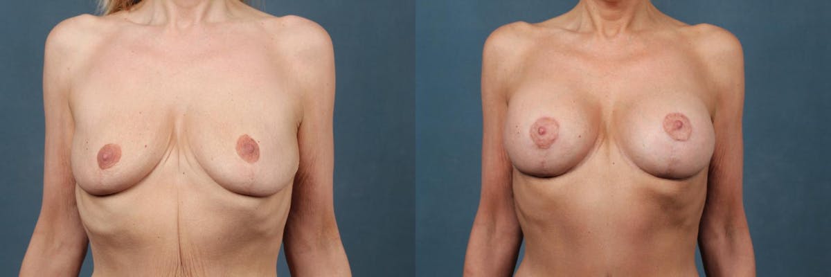 Lift Before & After Gallery - Patient 290717 - Image 1