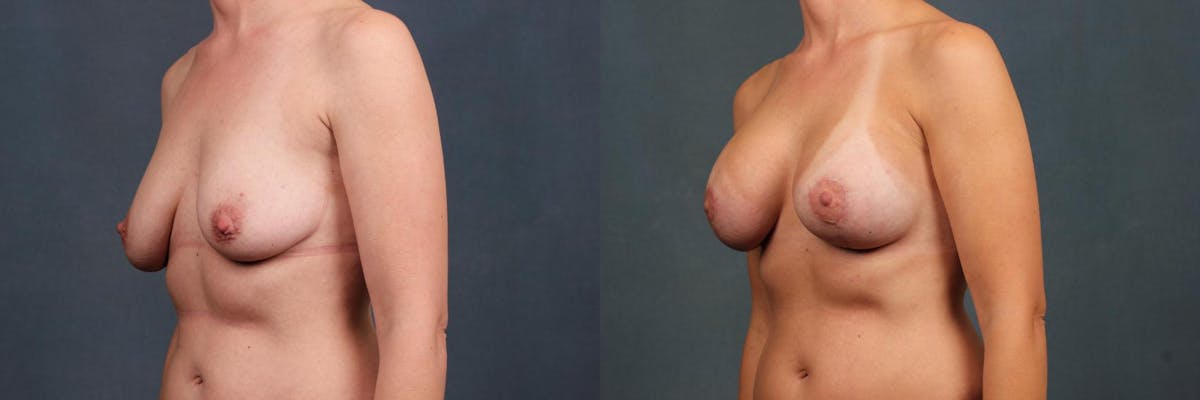 Lift Before & After Gallery - Patient 247767 - Image 2