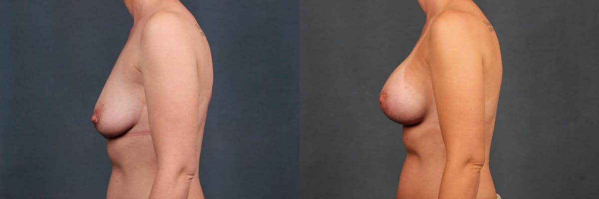 Lift Before & After Gallery - Patient 247767 - Image 3