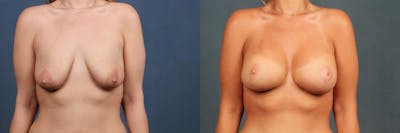 Lift Before & After Gallery - Patient 251740 - Image 1