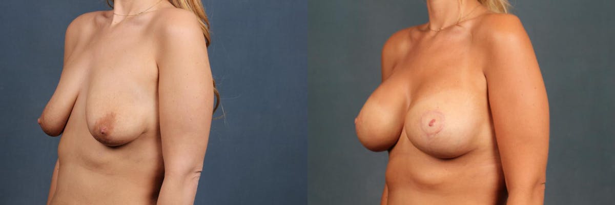 Lift Before & After Gallery - Patient 251740 - Image 2