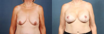Lift Before & After Gallery - Patient 423452 - Image 1