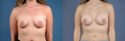 Lift Before & After Gallery - Patient 260059 - Image 1