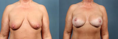 Lift Before & After Gallery - Patient 312201 - Image 1