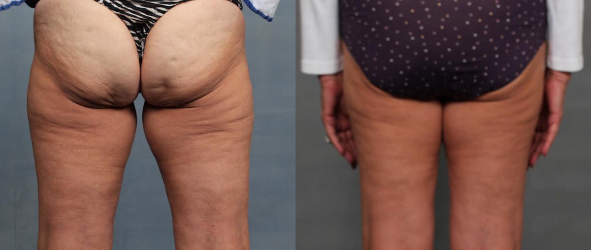 Cellulite Treatments Before & After Gallery - Patient 303047 - Image 1