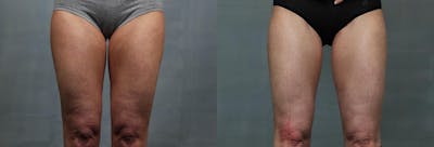 Cellulite Reduction Before & After Gallery - Patient 420546 - Image 1