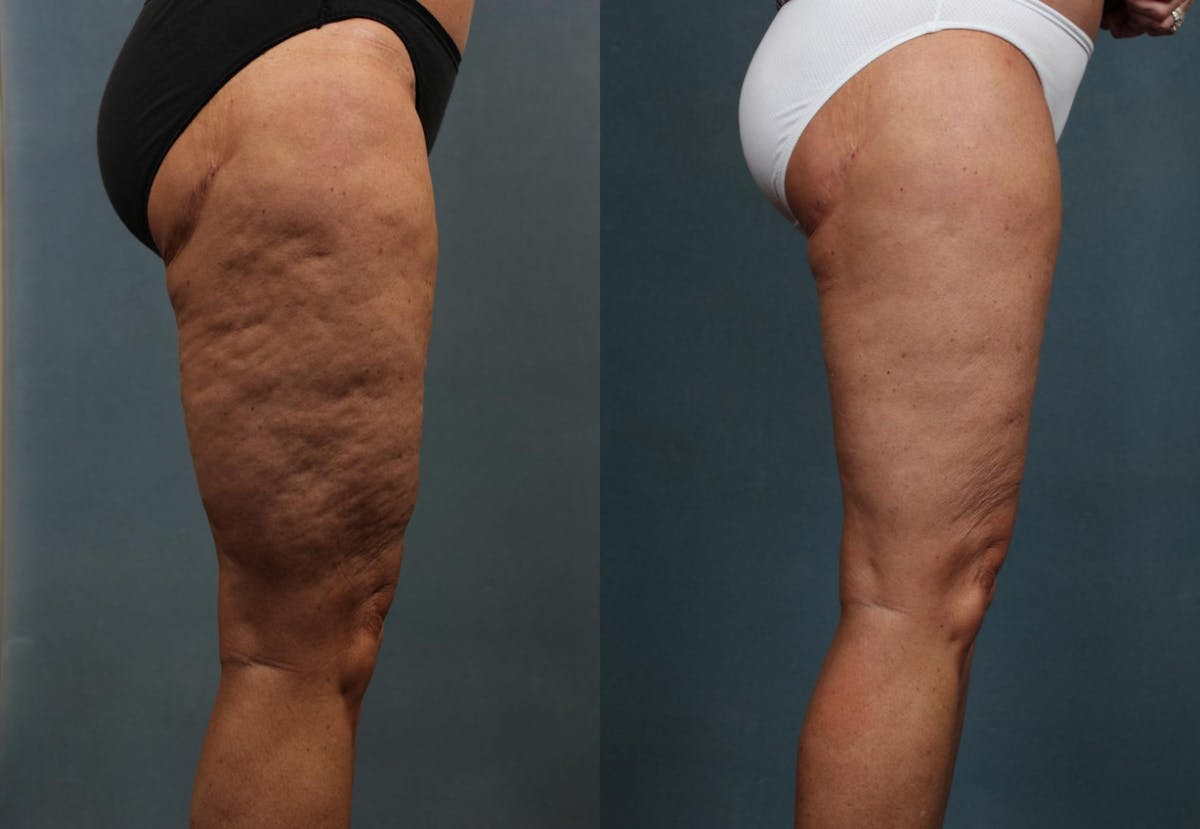 Cellulite Reduction Before & After Gallery - Patient 195664 - Image 2