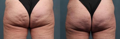 Cellulite Reduction Before & After Gallery - Patient 960519 - Image 1