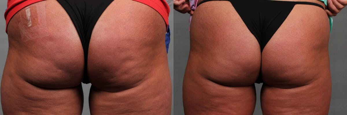 Cellulite Treatments Before & After Gallery - Patient 260914 - Image 1