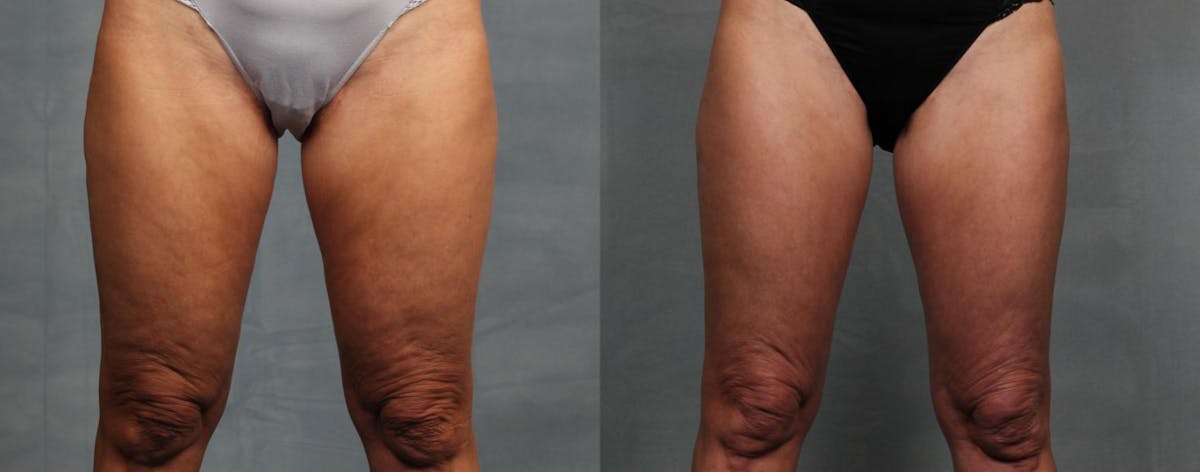 Cellulite Treatments Before & After Gallery - Patient 393524 - Image 1
