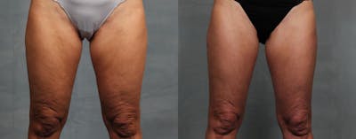 Cellulite Reduction Before & After Gallery - Patient 393524 - Image 1