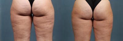 Cellulite Reduction Before & After Gallery - Patient 411877 - Image 1