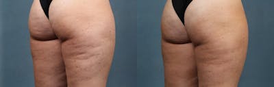 Cellulite Reduction Before & After Gallery - Patient 879101 - Image 1