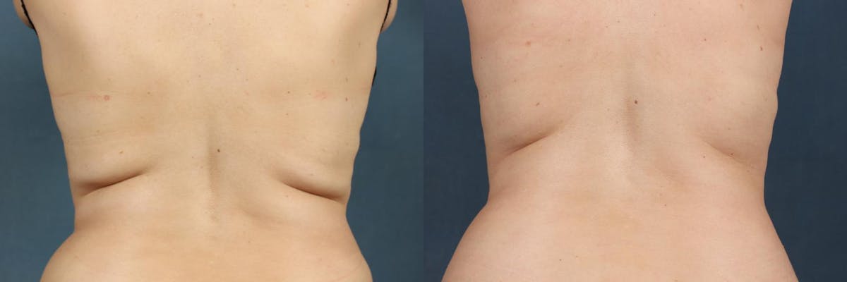 CoolSculpting Before & After Gallery - Patient 399641 - Image 1