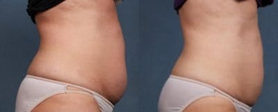 CoolSculpting Before & After Gallery - Patient 424037 - Image 1