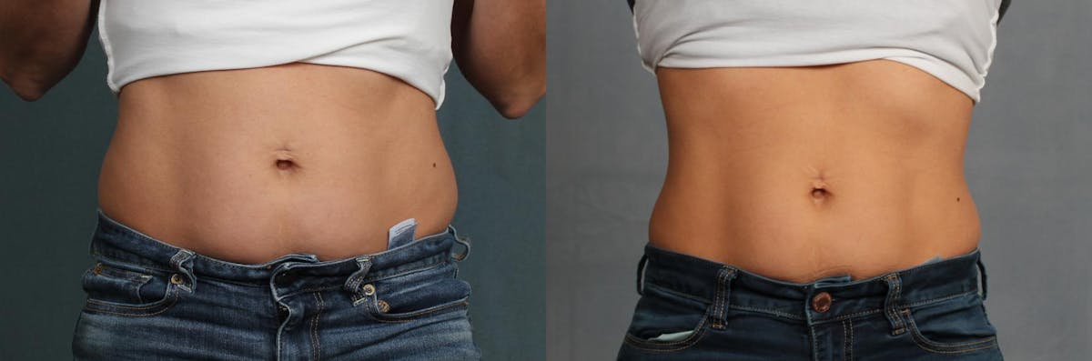 CoolSculpting Before & After Gallery - Patient 106924 - Image 1