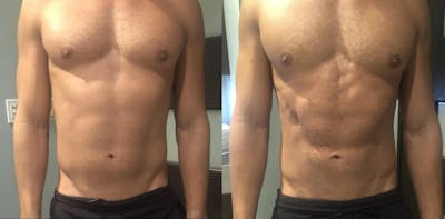 Male EMSculpt Before & After Gallery - Patient 117264 - Image 1