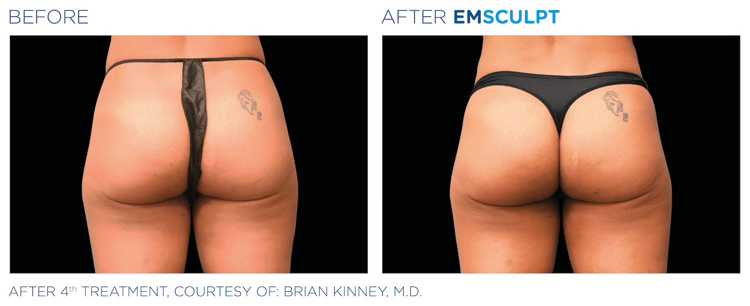 emsculpt results